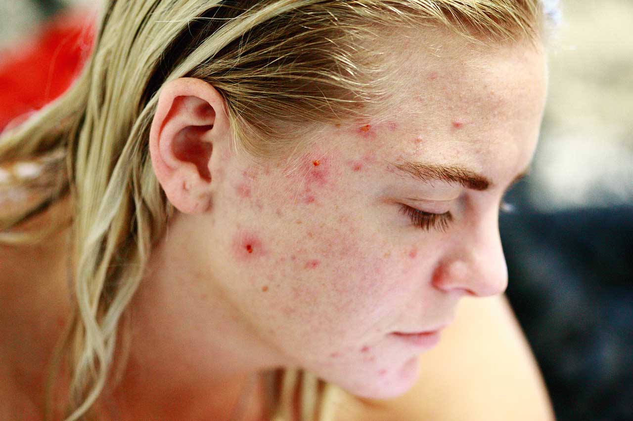 chica con acne vitamina b5 para el acne